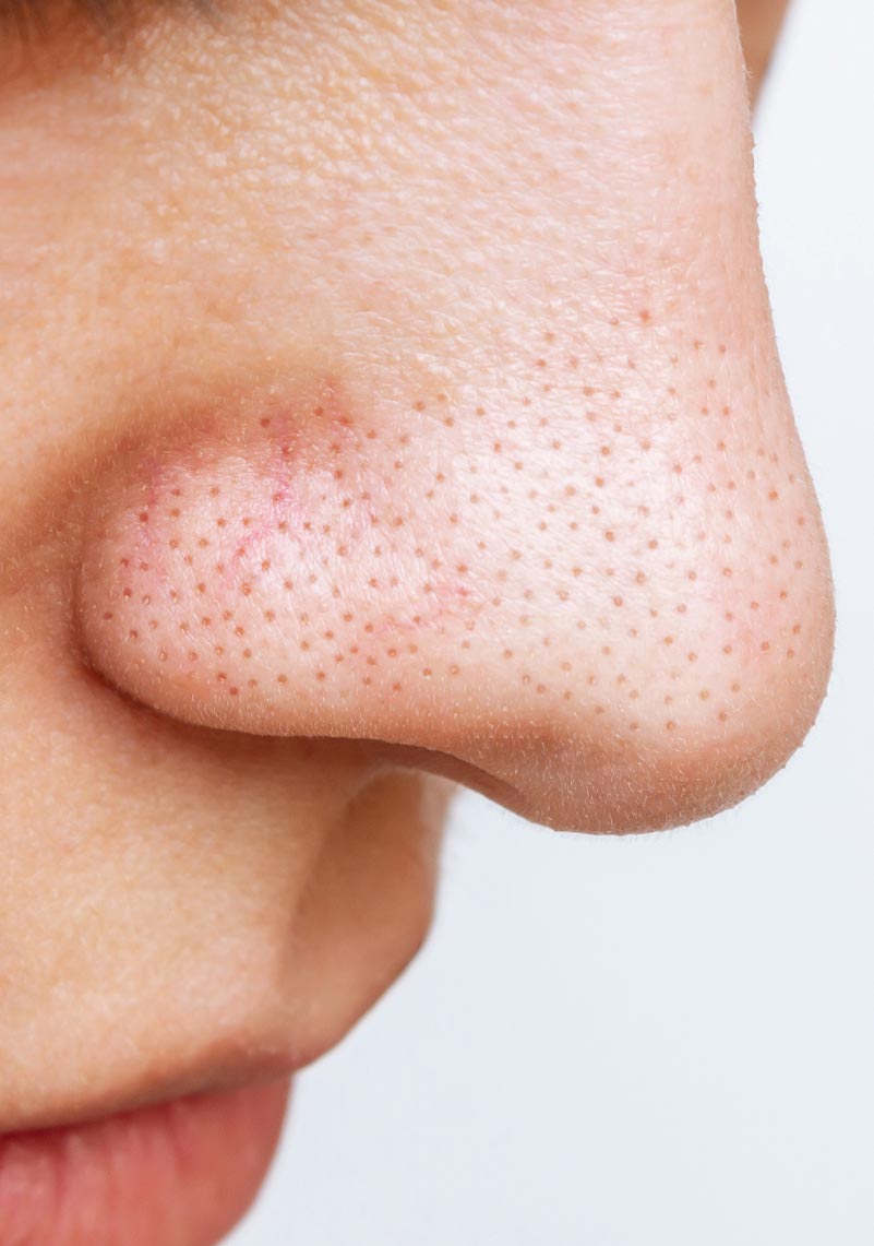 the-facebible-enlarged-pores-blackheads-1