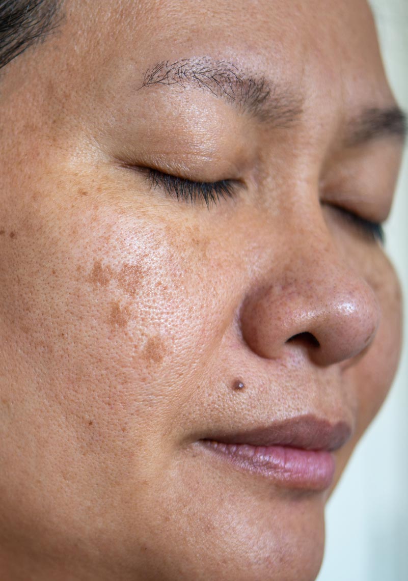 https://www.thefacebible.com/wp-content/uploads/2022/06/the-facebible-melasma-1.jpg