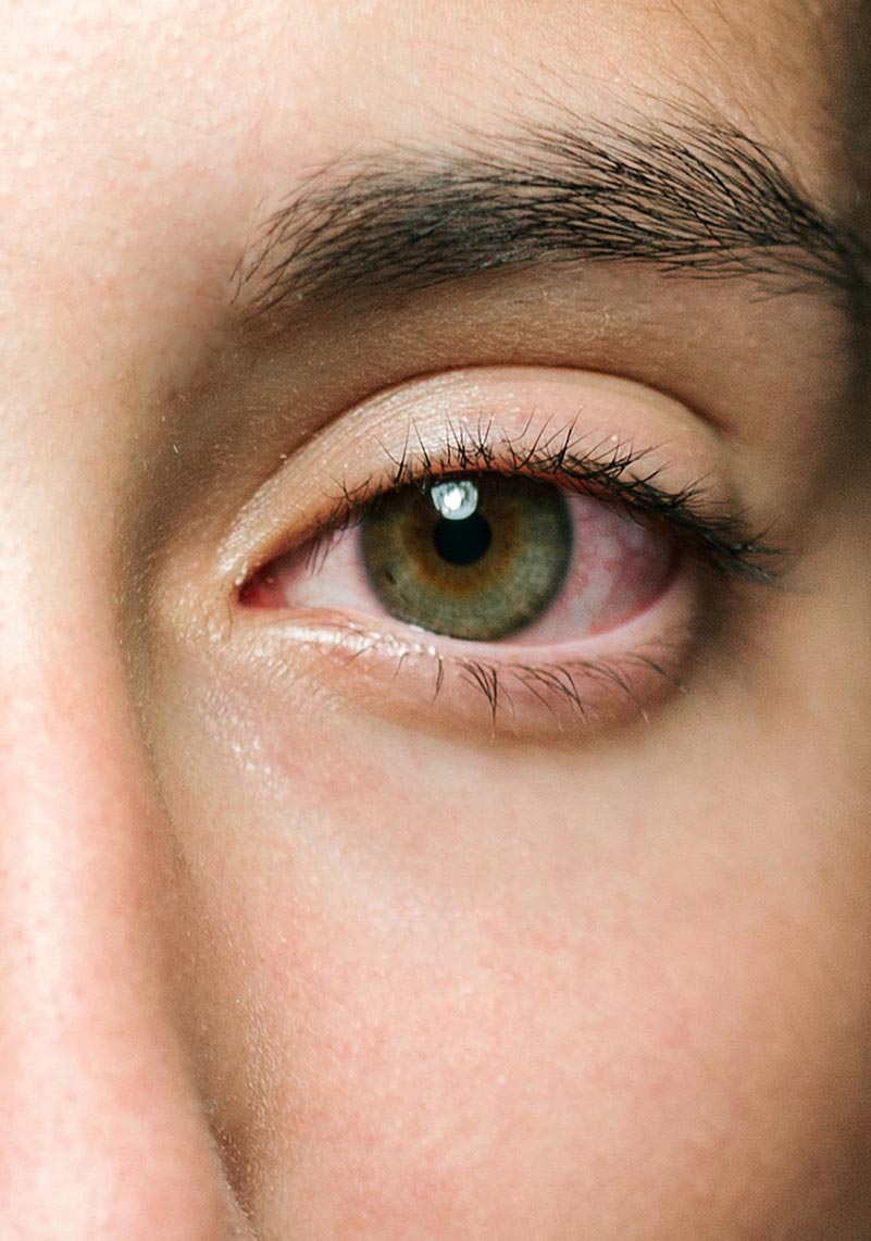 What causes puffy eyes?