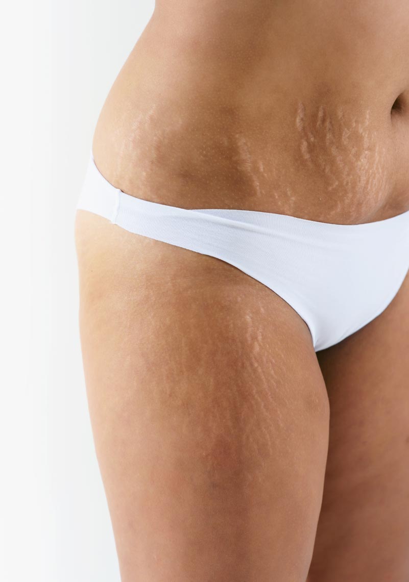 the-facebible-stretch-marks-1